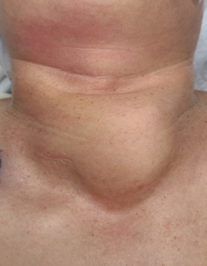 Thyroid cancer is among the most prevalent cancers in Hong Kong and the world. Precision management requires accurate disease staging and clinical risk stratification. This process is currently done manually by doctors who would have to go through a large volume of complex clinical information, which could be time consuming.
 